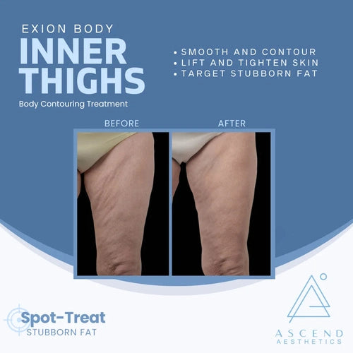 Exion Body Contouring Treatment - (Inner Thighs)