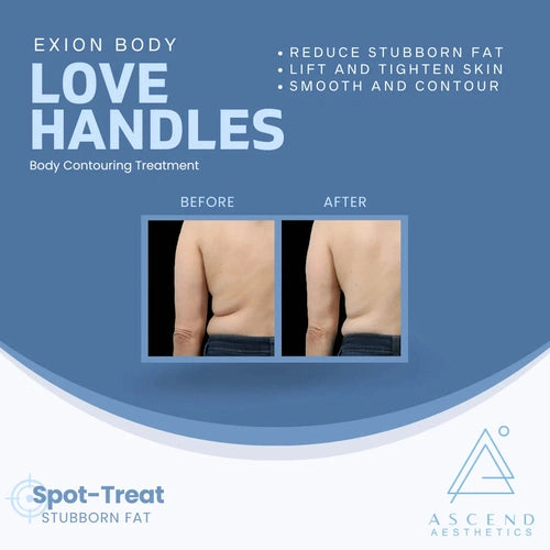 Exion Body Contouring Treatment - (Love handles)