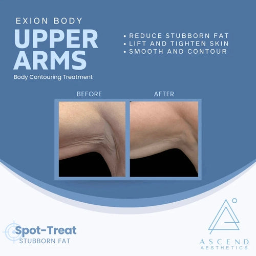 Exion Body Contouring Treatment (Upper arms)