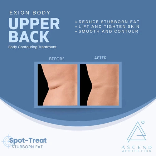 Exion Body Treatment - (Upper Back/Bra Fat Area)
