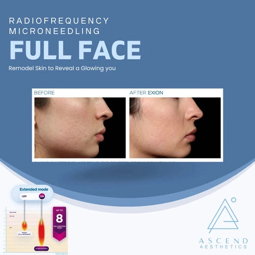 Microneedling - (Face)