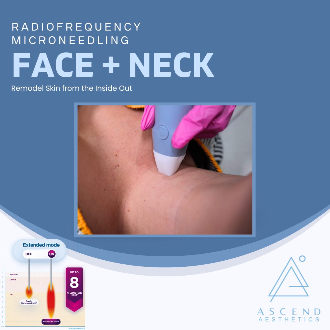 Radiofrequency Microneedling: Face + Neck