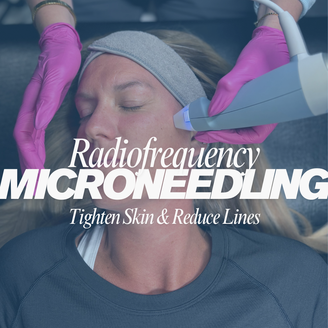 Radiofrequency Microneedling