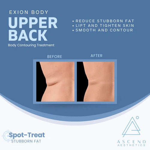 Contouring Treatment - (Upper Back) - Bra Fat Area