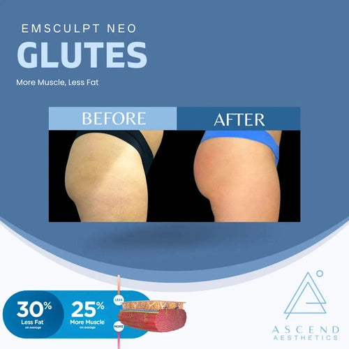 Emsculpt Neo - (Glutes )