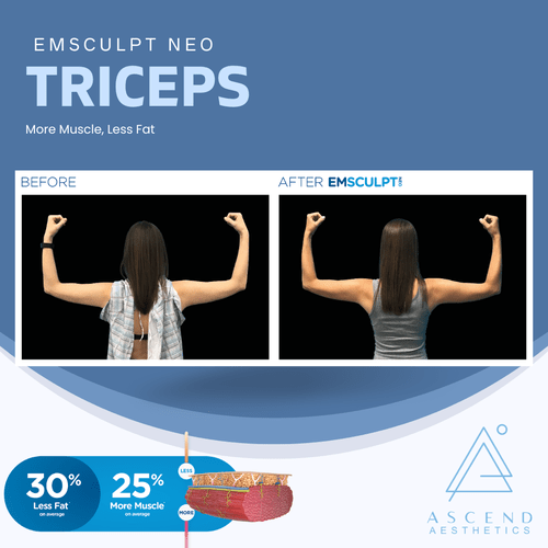 Emsculpt Neo - (Triceps)