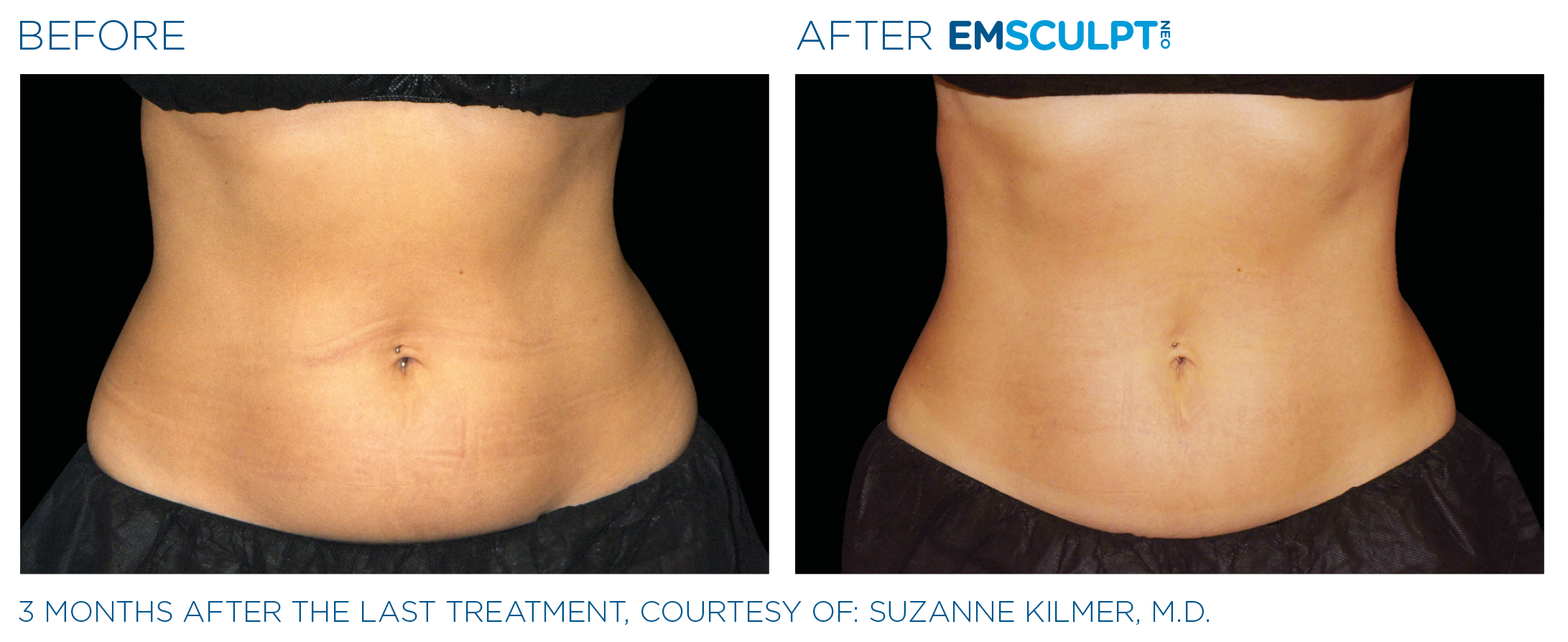 $49 Waistline Sculpting Demo – Emsculpt Neo Edge