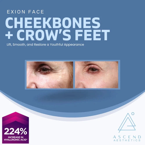 Exion Face - (Cheekbones + Crow’s Feet)