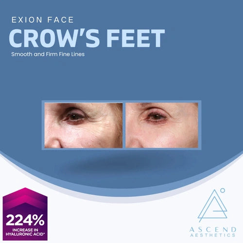 Exion Face - (Crow’s Feet)