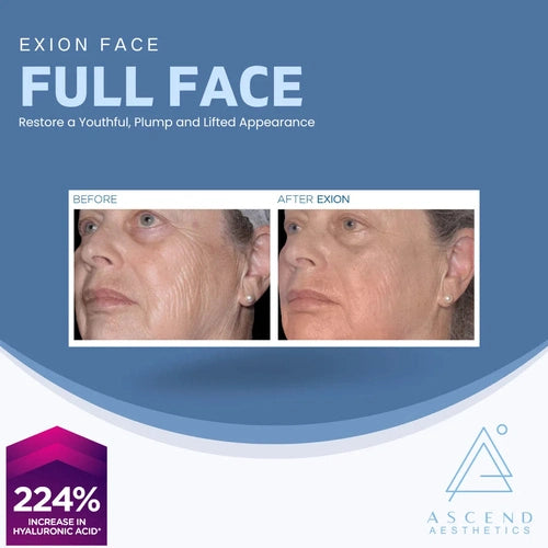 Exion Face - (Full Face)