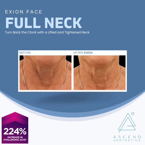 Exion Face - (Full Neck)