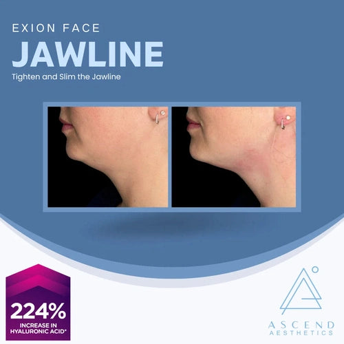 Exion Face - (Jawline )