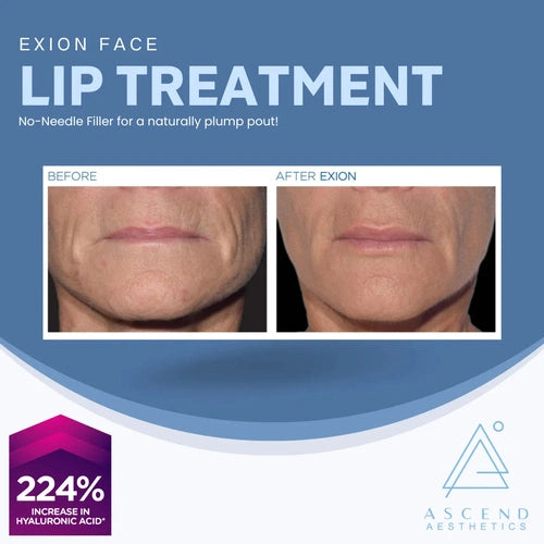 Exion Face - (Lip Treatment)