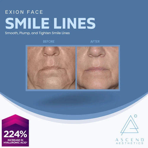 Exion Face - (Smile + Lip Lines)