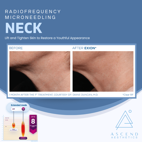 Microneedling - (Neck)