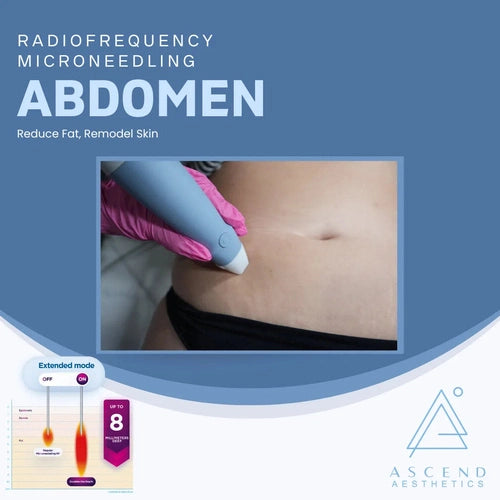 Microneedling - (Abdomen)